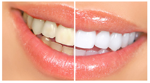 HOT or NOT | Home remedies fo bleaching your teeth
